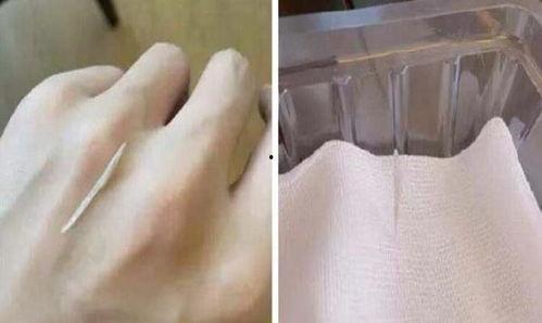 吃瓜卡在食道,吃瓜卡引发的意外之旅